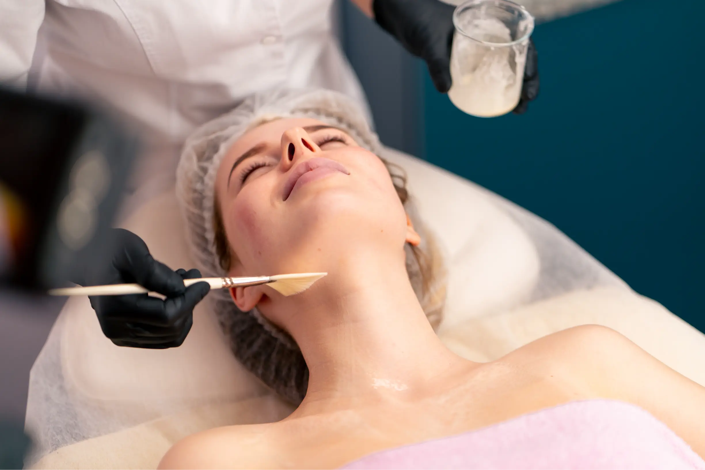 Application of a chemical peel during a skincare treatment.