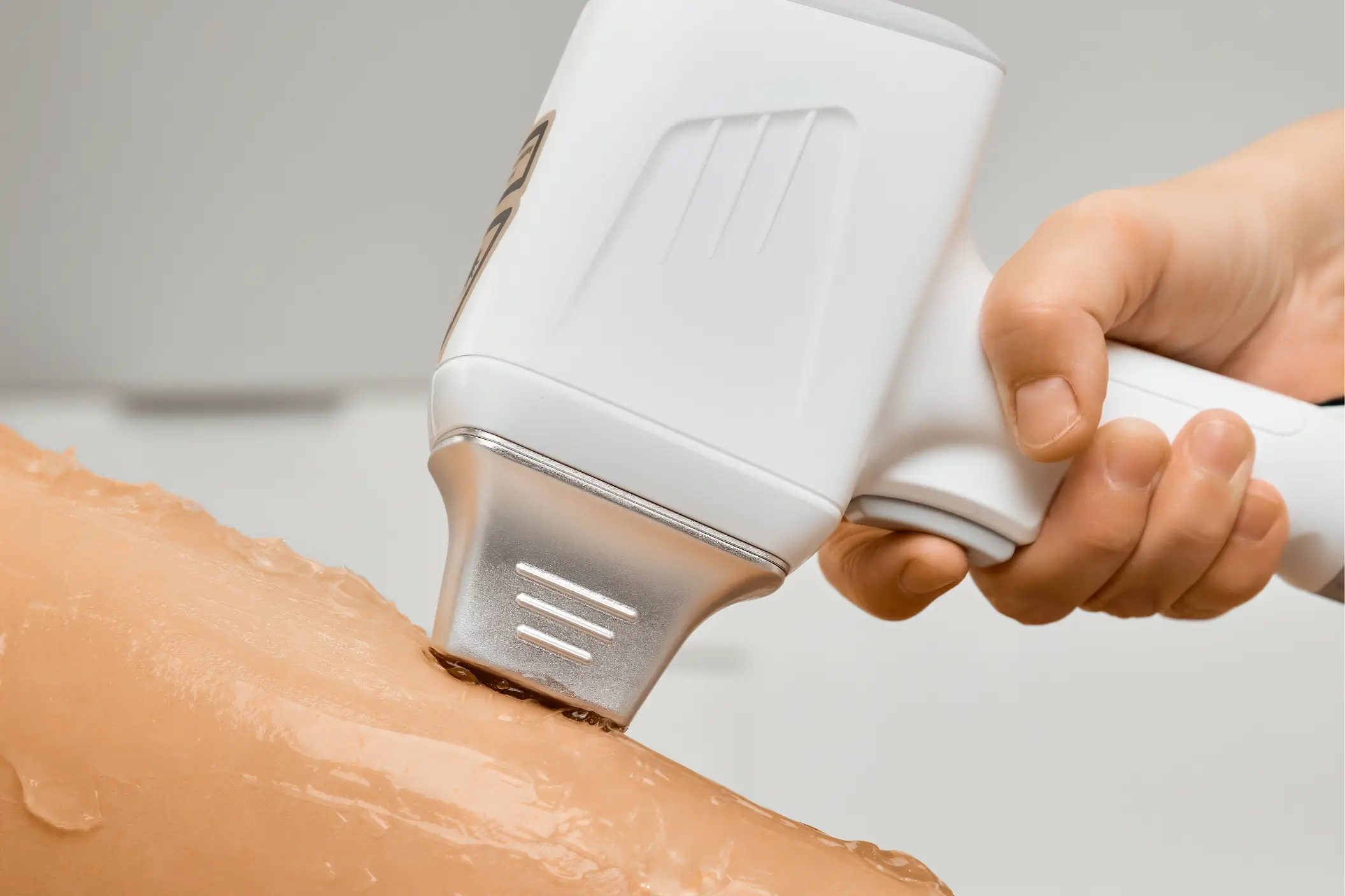 Laser hair removal treatment using the PRIMELASE system for smooth, hair-free skin.